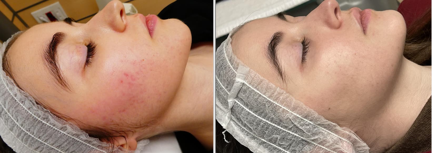 tratamiento laser para el acne