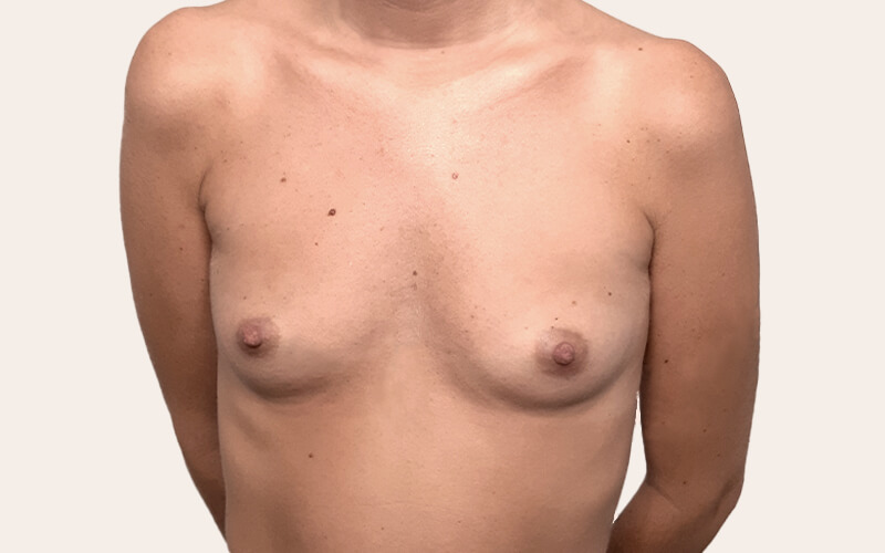 Caso real antes pecho