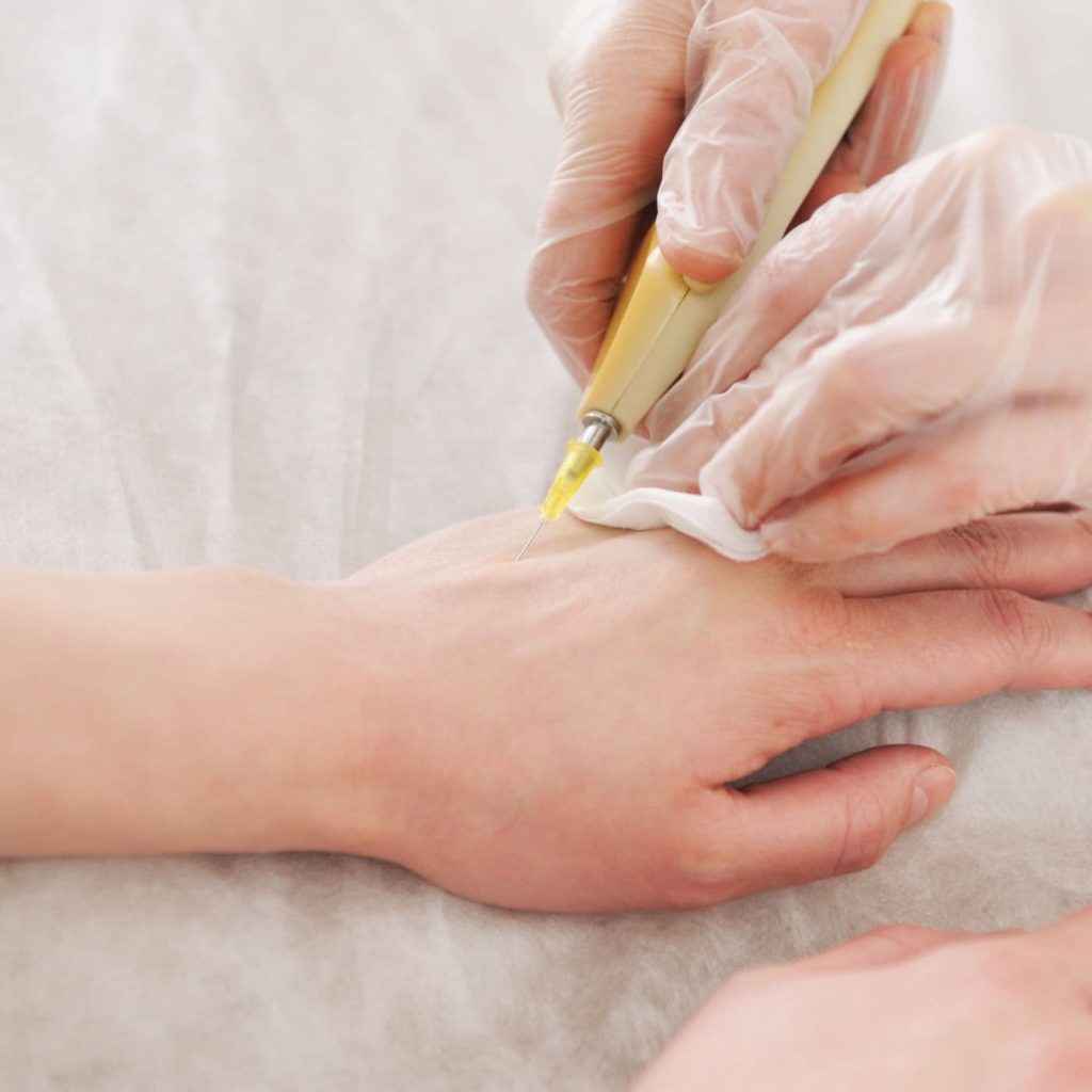 Ventajas de la Mesoterapia corporal