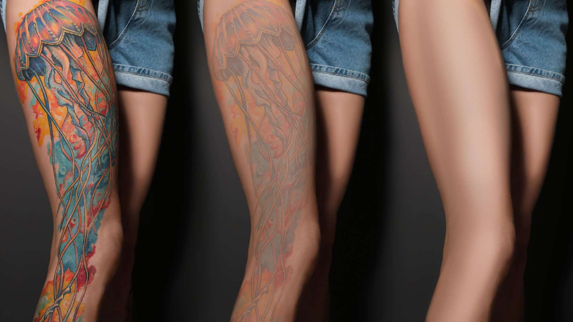 qswitched para eliminar tatuajes