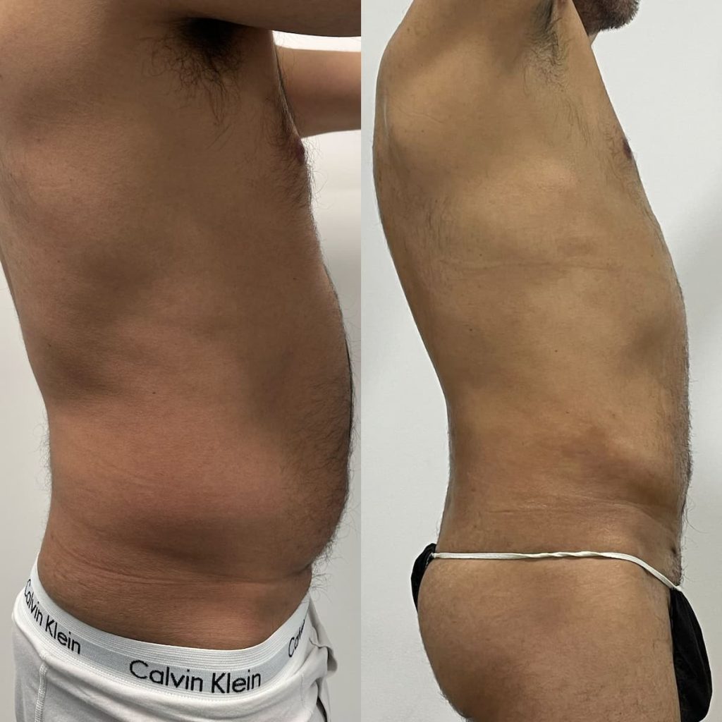 Liposuccion antes y después