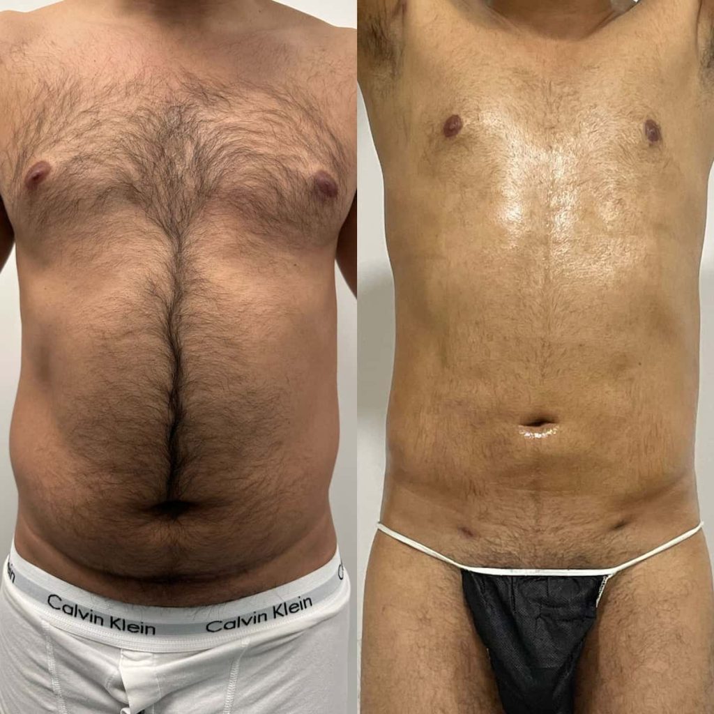 Resultados de una liposucción