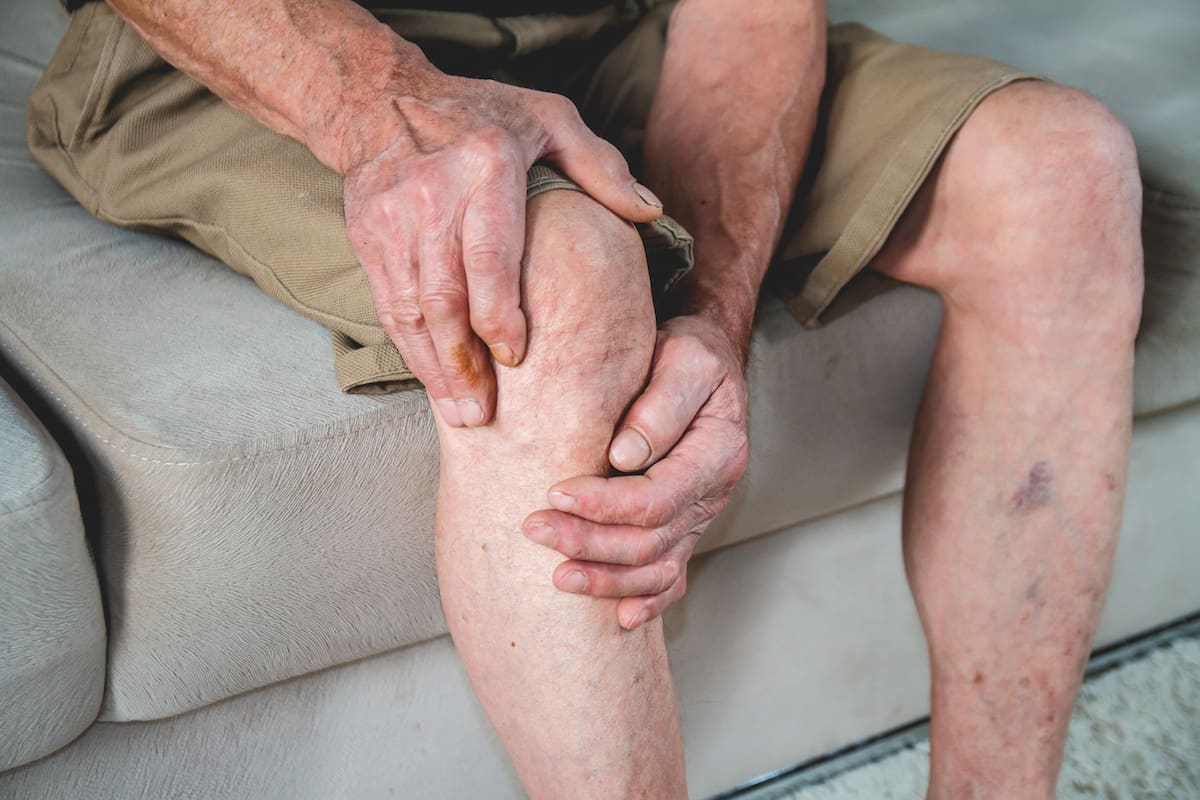 Causas de las varices en los hombres