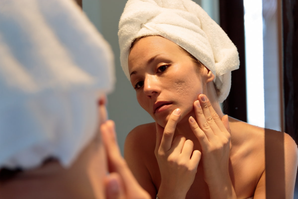 eliminar cicatrices profundas acne