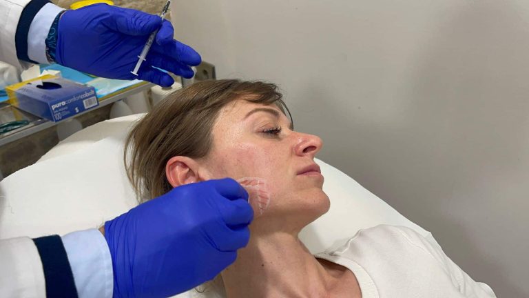 toxina botulínica para el bruxismo