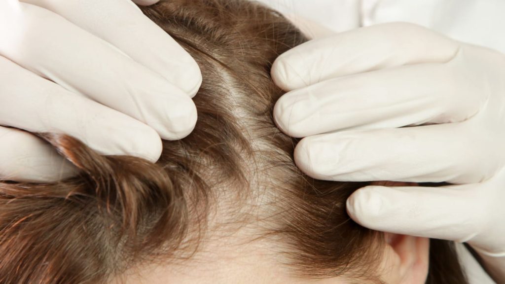 Caída del cabello en invierno