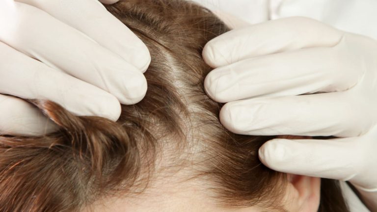 Caída del cabello en invierno