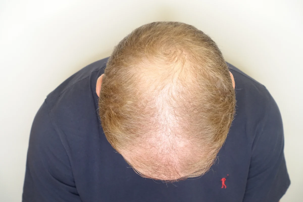 Antes de la alopecia androgénica