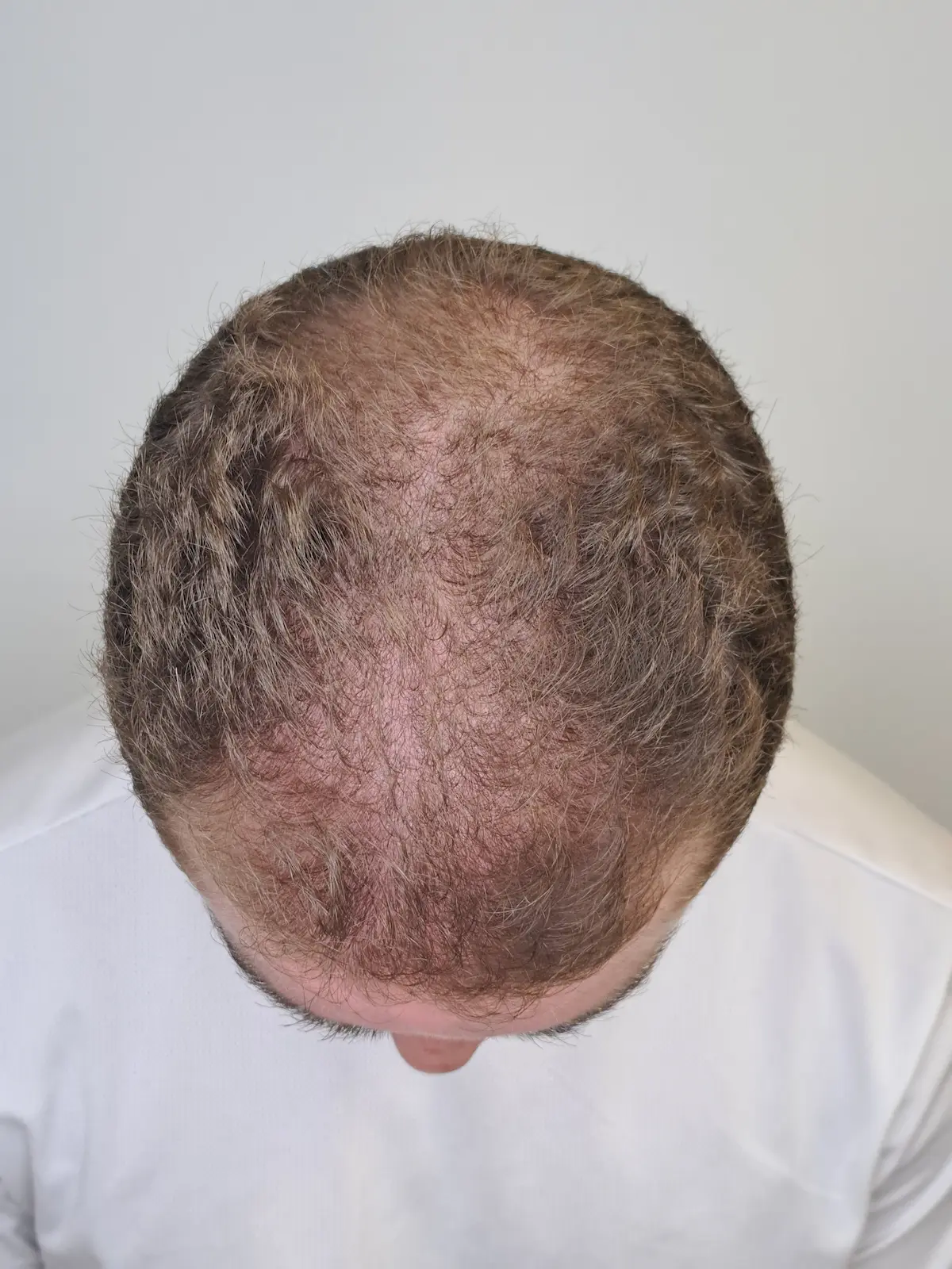 Después alopecia androgénica