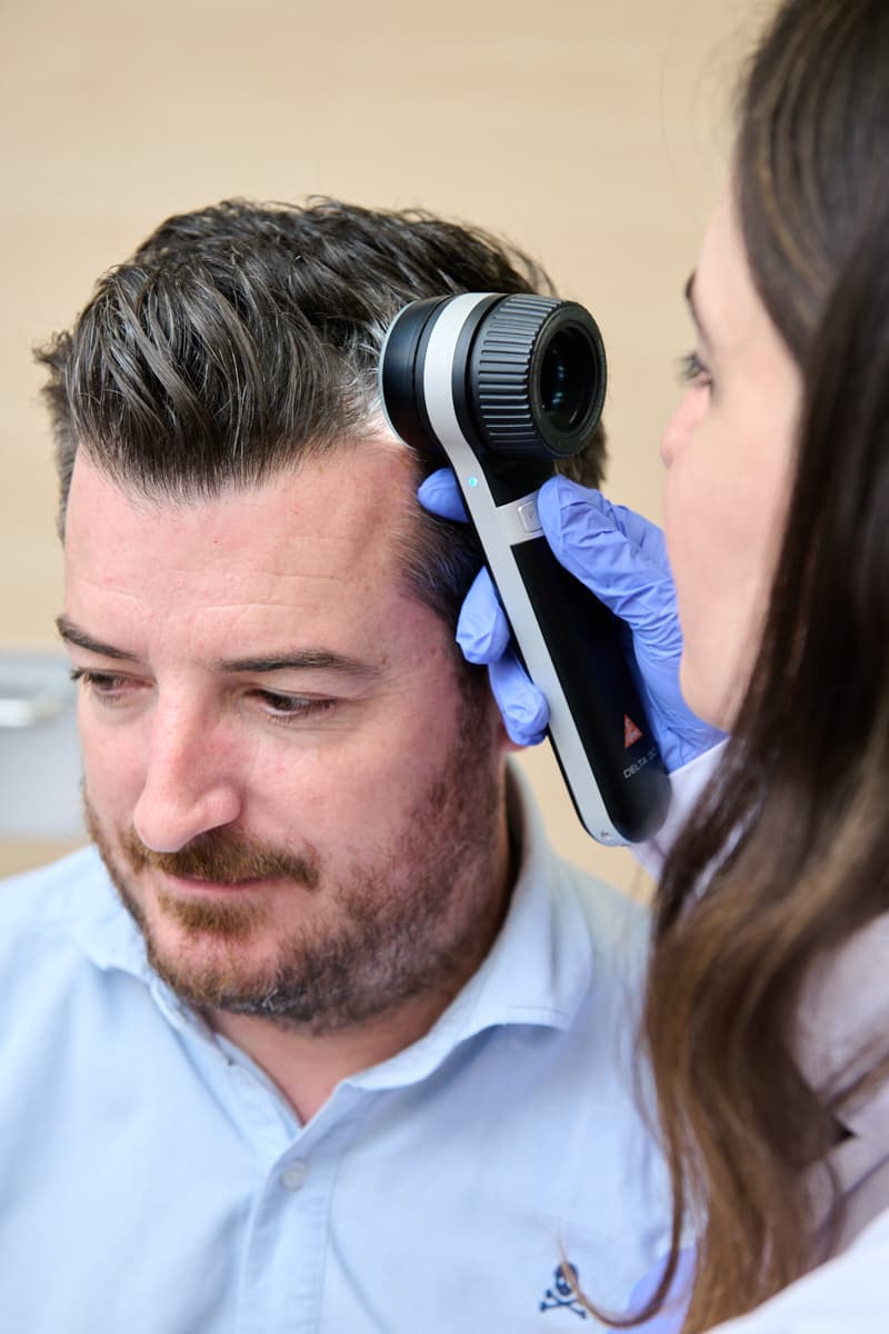 Cómo tratar la alopecia androgénica