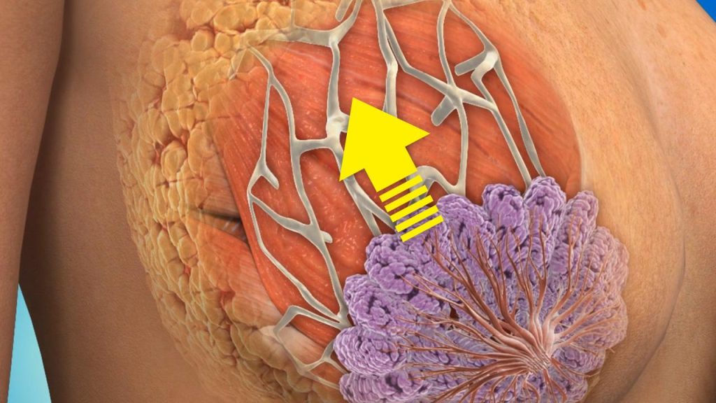 Es posible la elevación de pecho sin prótesis