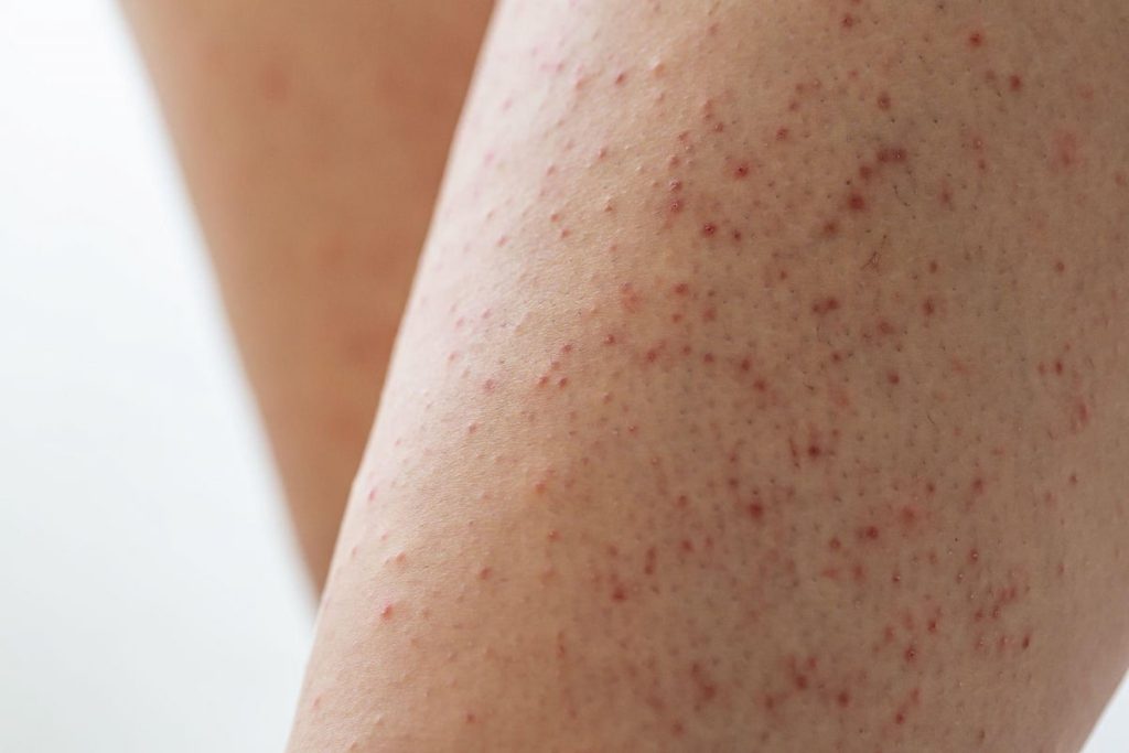 Primer plano de la piel con pequeños granitos rojizos y textura rugosa, característicos de la queratosis pilaris