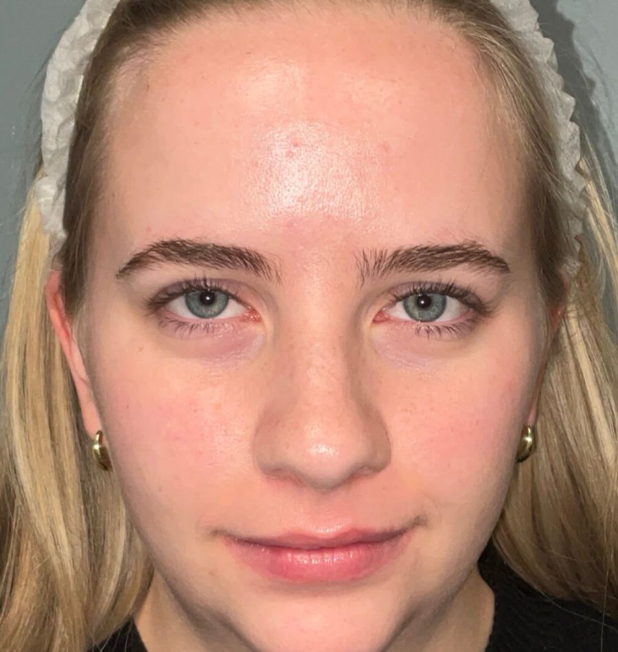 Acné después copia-2