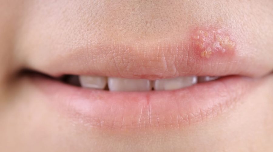 Herpes simple