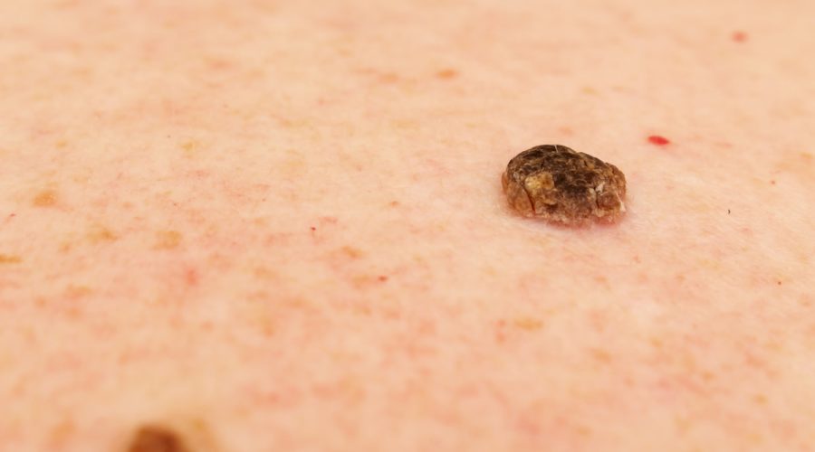 Queratosis actínicas