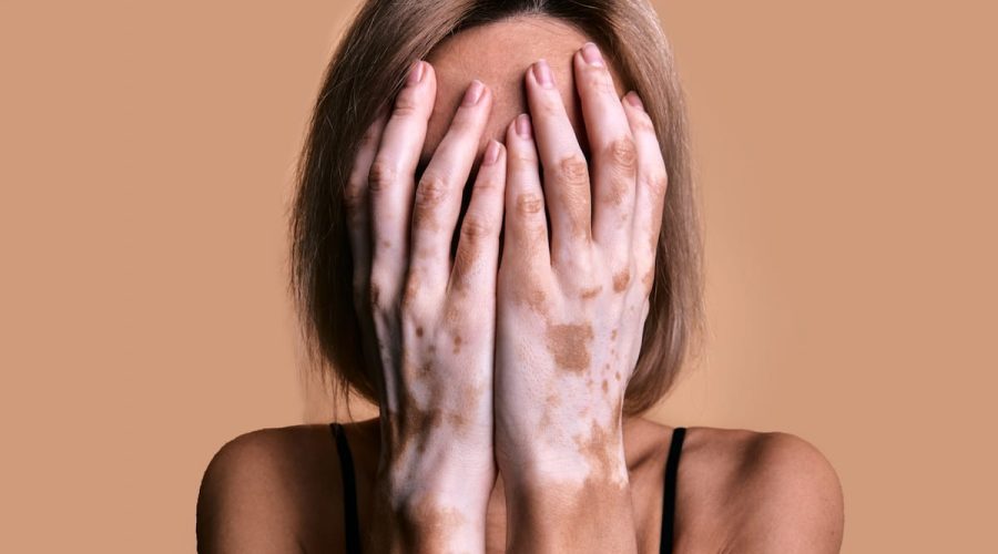 Vitíligo
