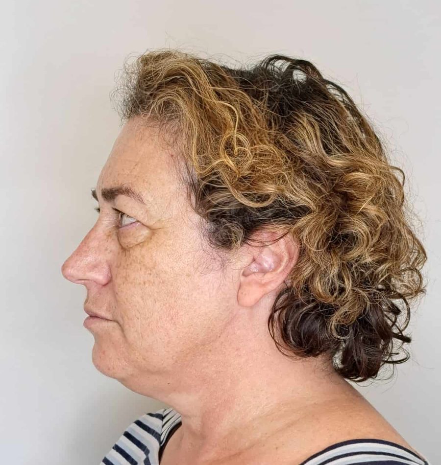 Antes del tratamiento para las manchas en la cara