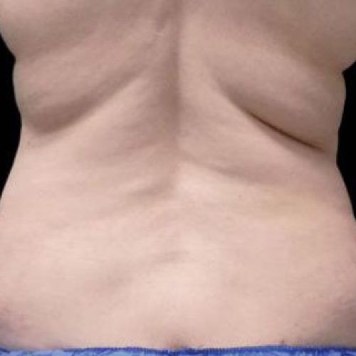 coolsculpting-antes1