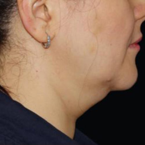 coolsculpting-antes2