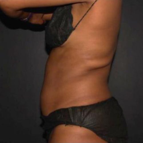 coolsculpting-despues
