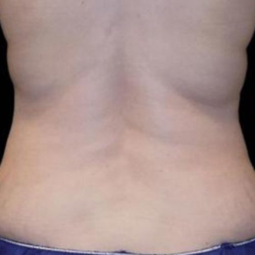 coolsculpting-despues1