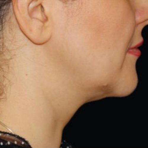 coolsculpting-despues2