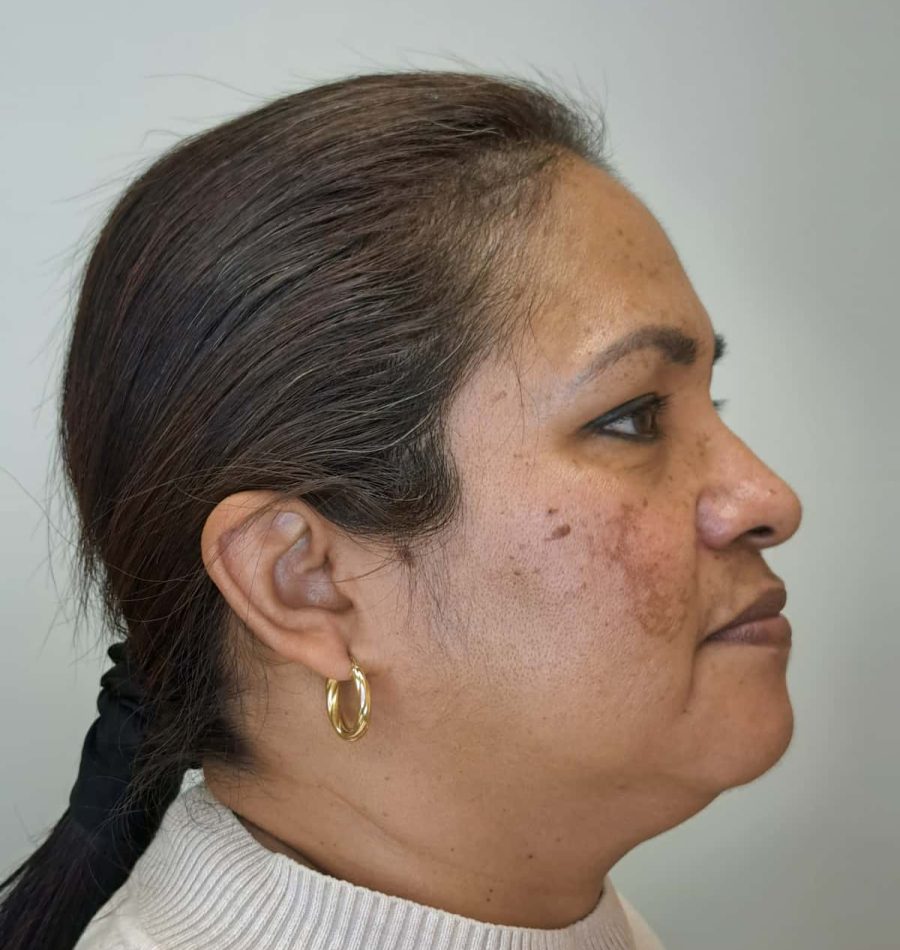 antes del tratamiento para el melasma